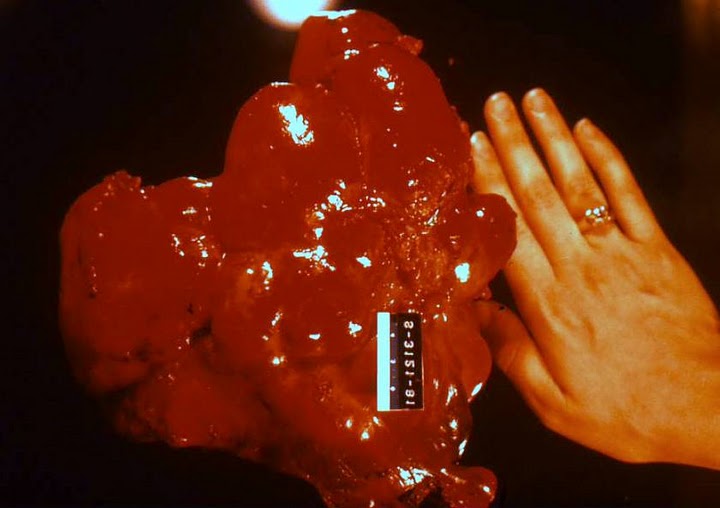 Echinococcus granulosus..JPG